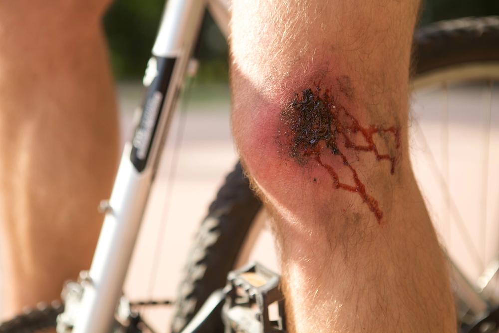A cyclist who suffered road rash after a severe bike accident.